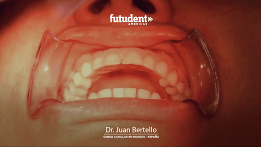 Dr. Juan Bertello, video exclusivo: Curso de Carillas con micro cámaras Futudent